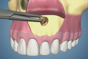 Apical Surgery Cyst Removal-Anterior with Sinus